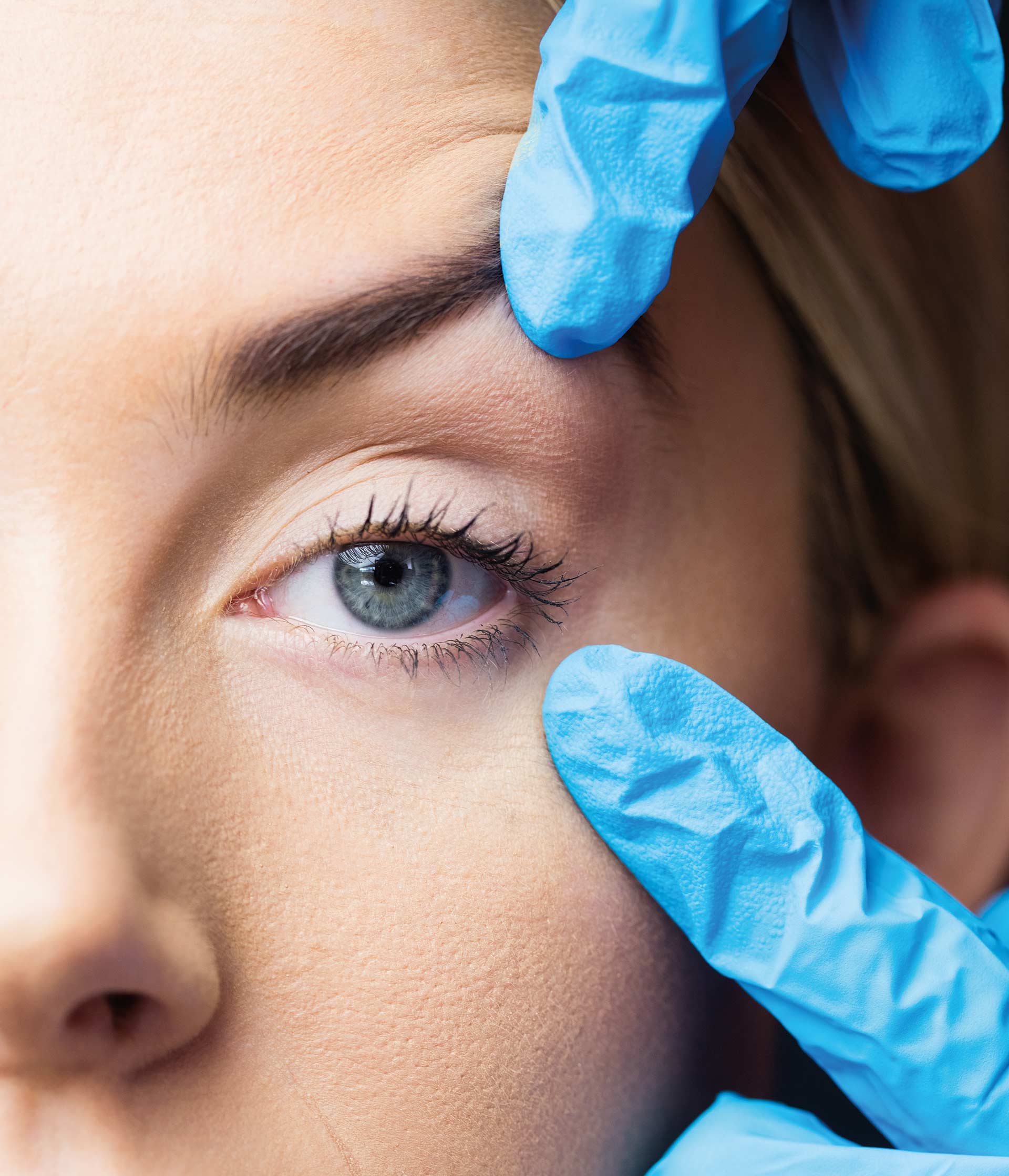 Blefaroplastia