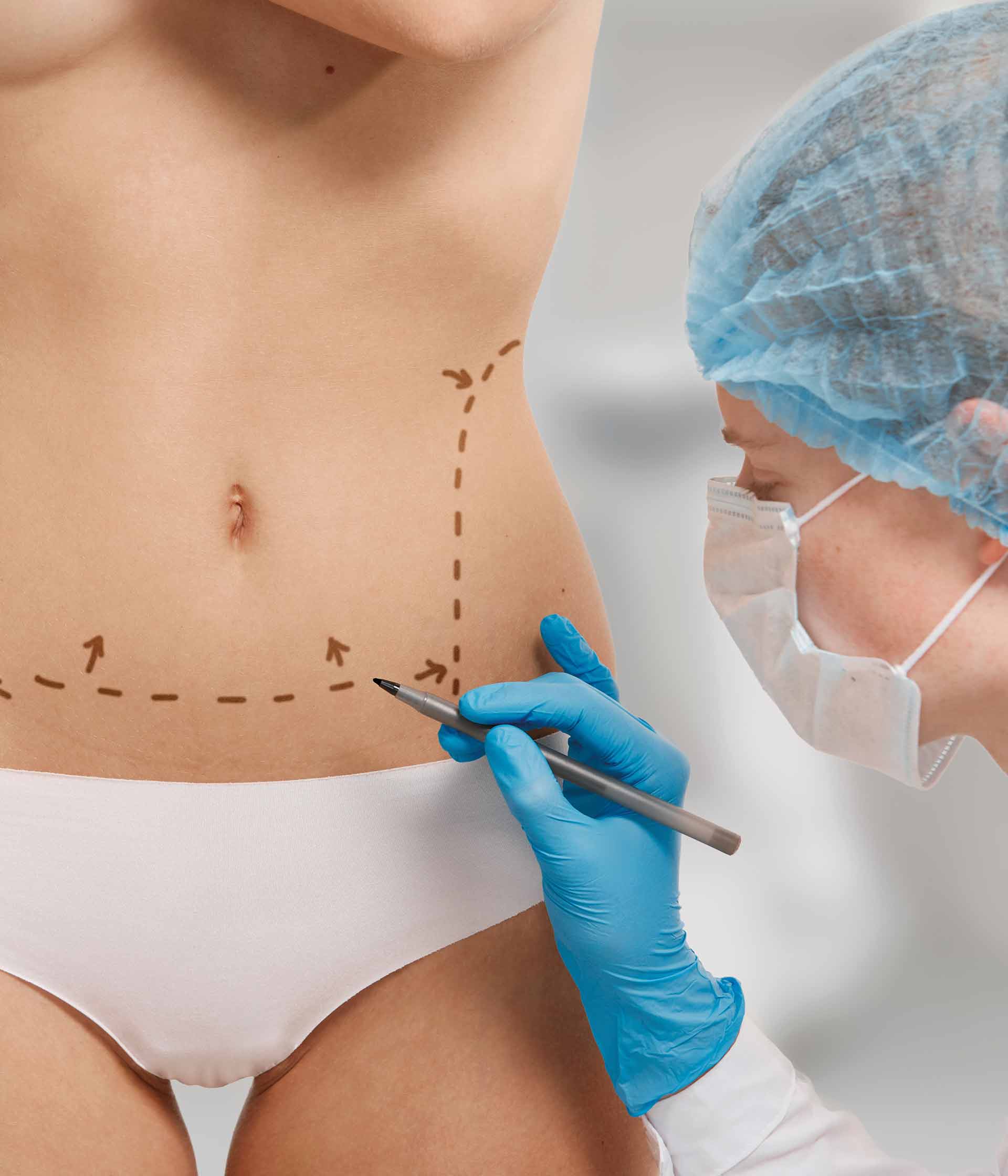 Abdominoplastia