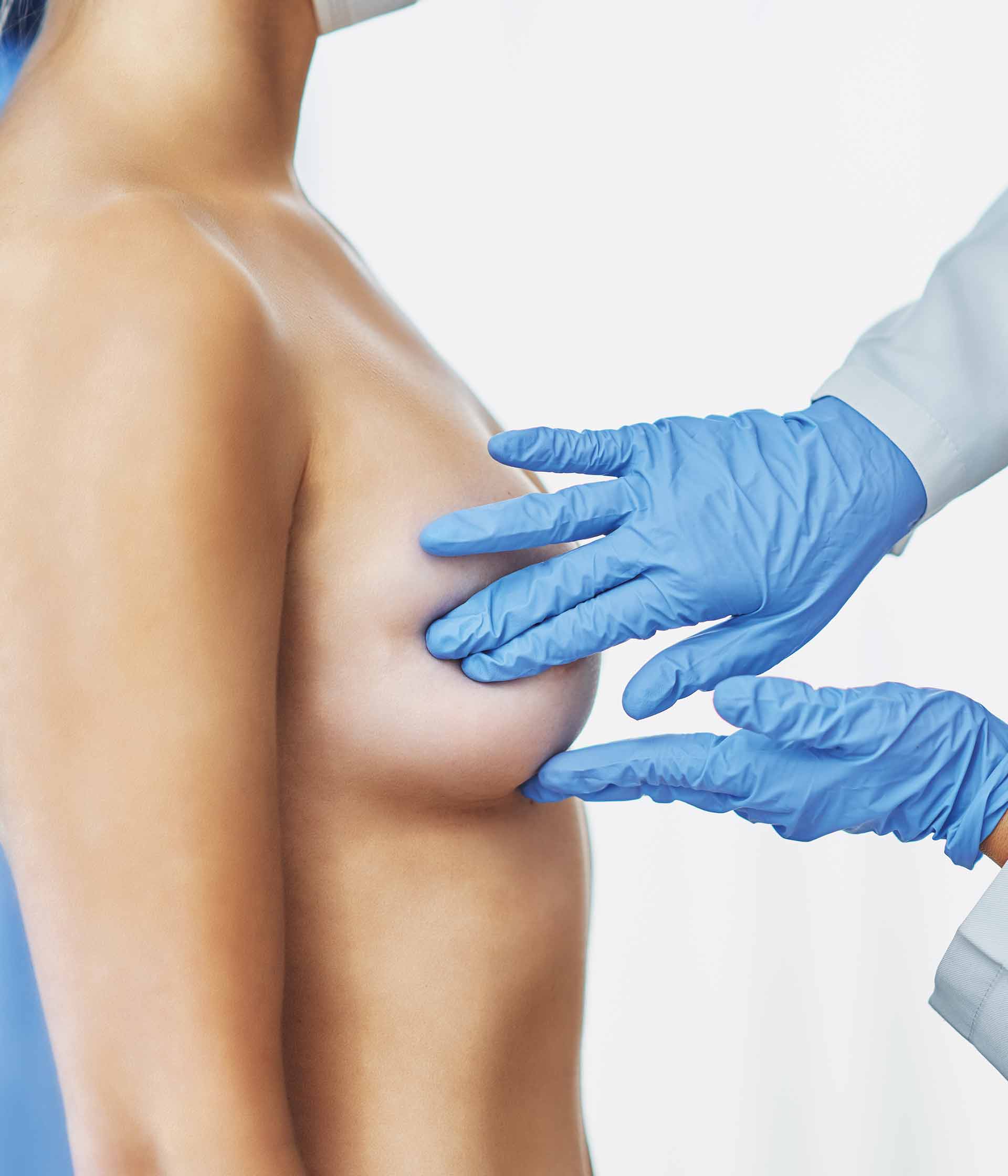 Mamoplastia de reducción